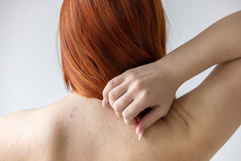 Body Acne by Area Explained